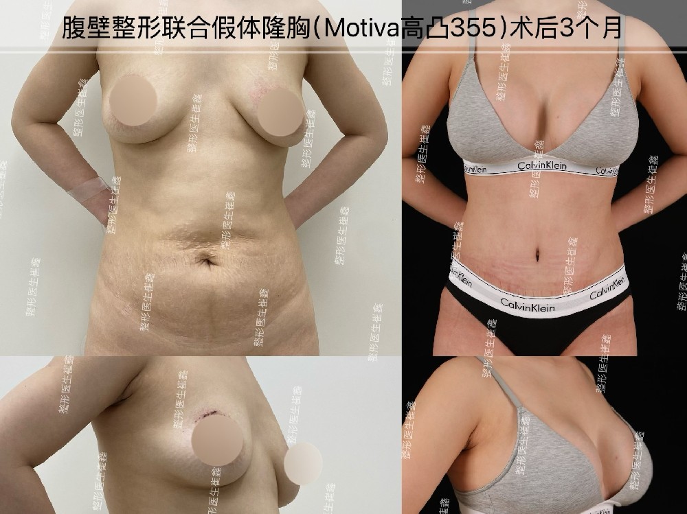 腹壁整形联合假体隆胸（Motiva高凸355）术后3个月