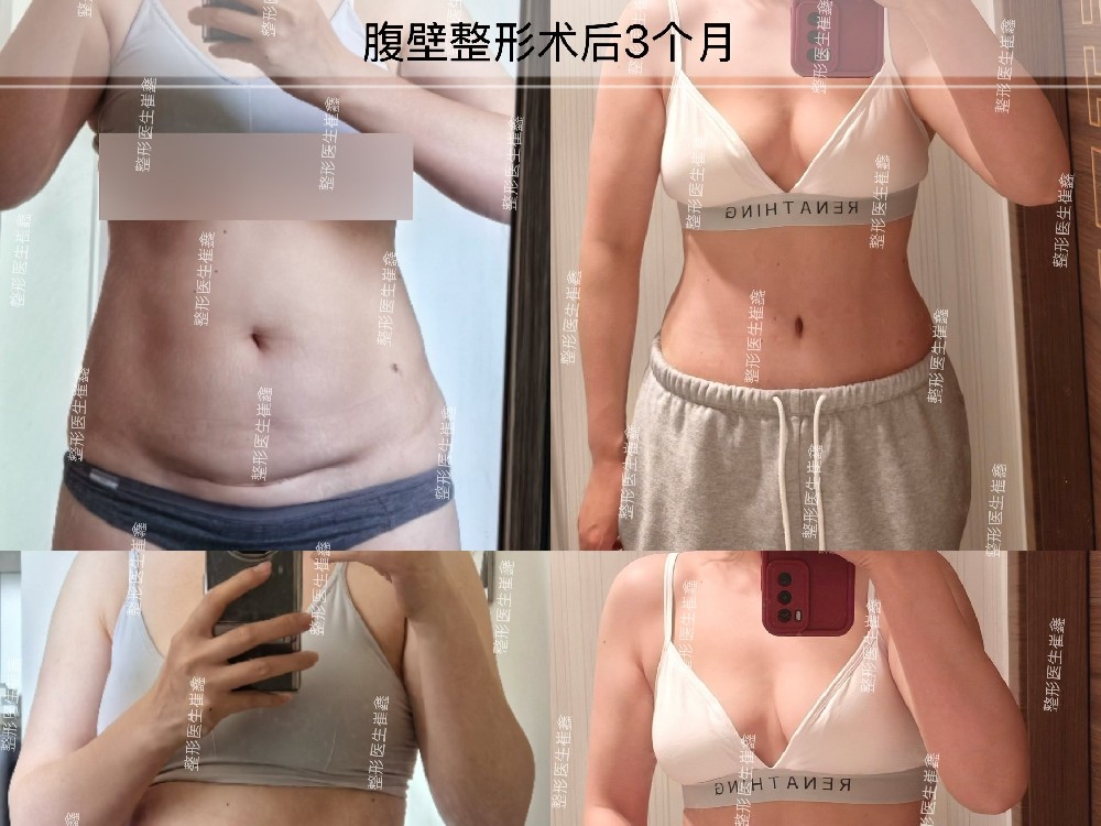 腹壁整形术后3个月