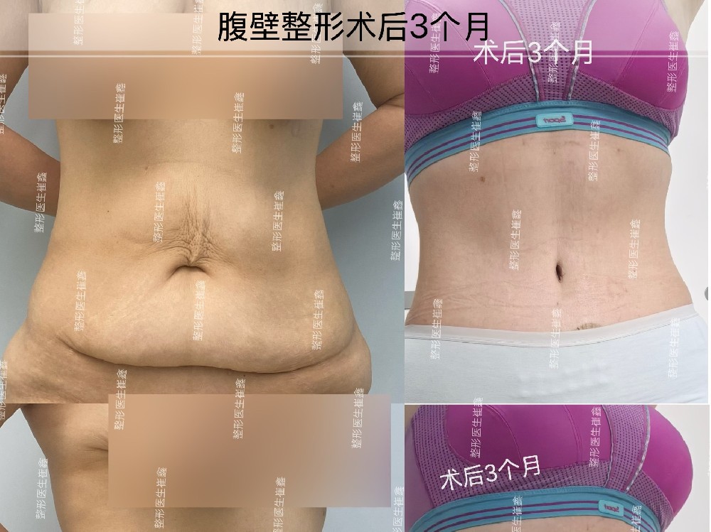 腹壁整形术后3个月