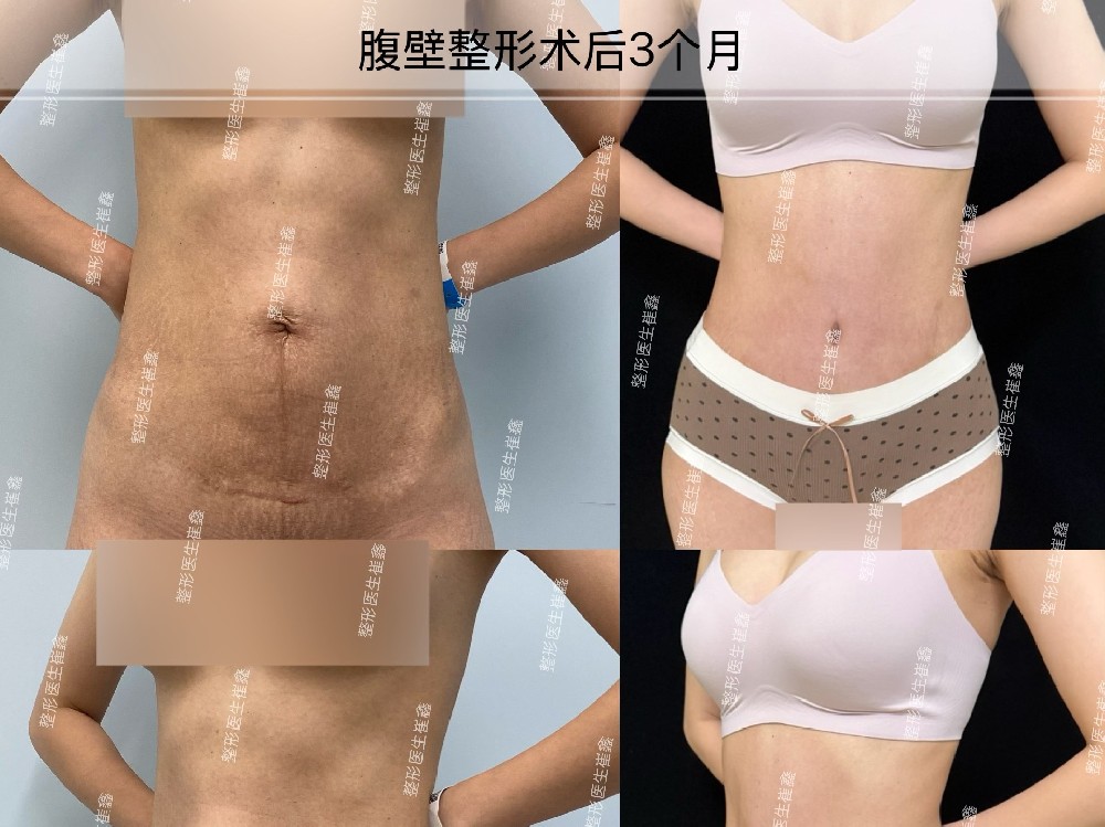 腹壁整形术后3个月