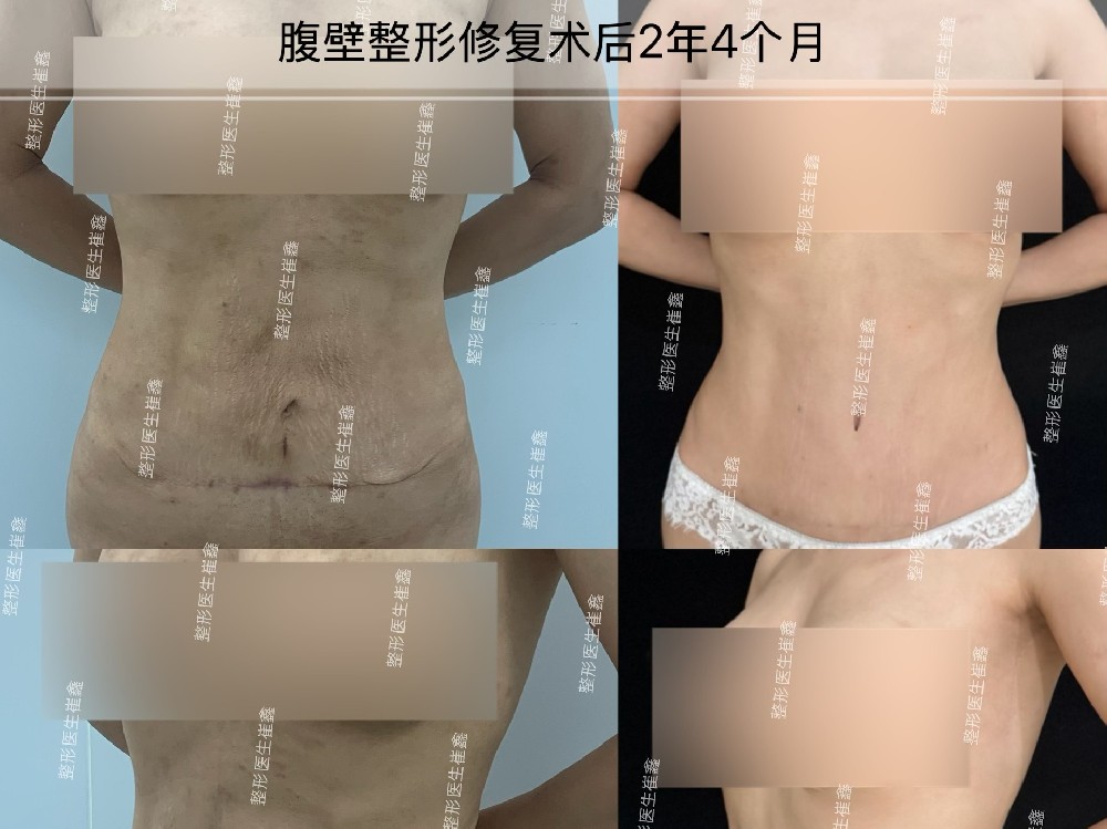 腹壁整形修复术后2年4个月