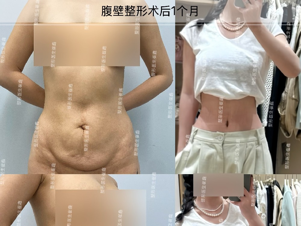 腹壁整形术后1个月