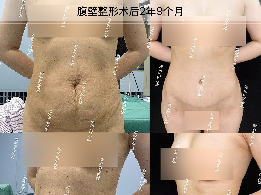 腹壁整形术后2年9个月