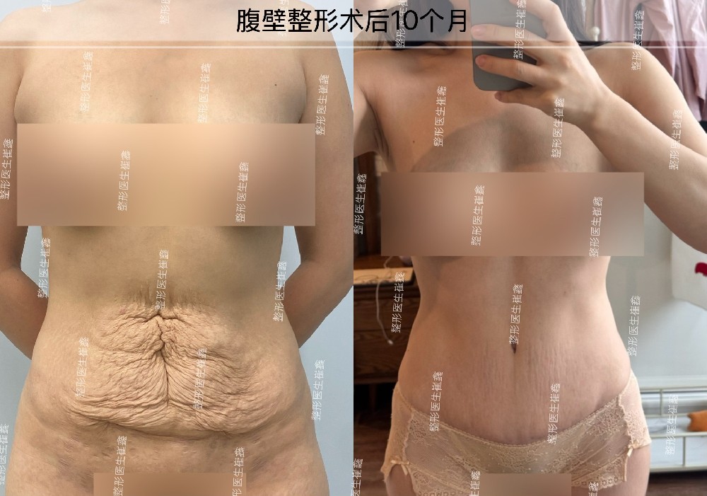 腹壁整形术后10个月