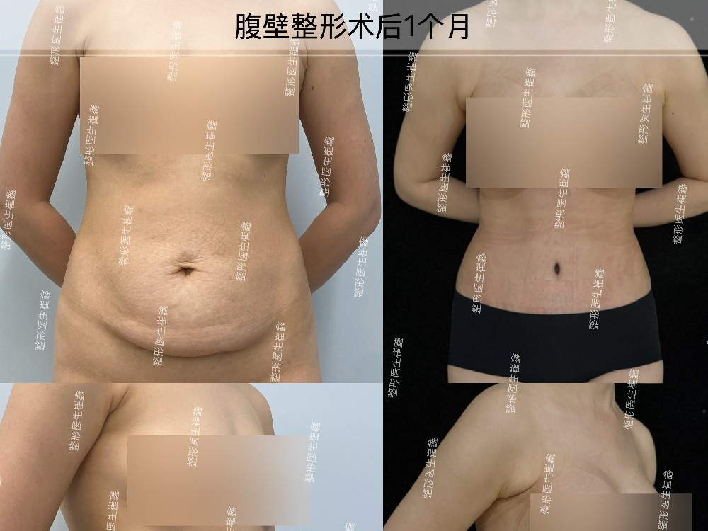 腹壁整形术后个月