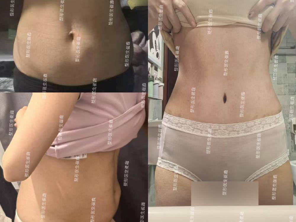 腹壁整形术后5个月