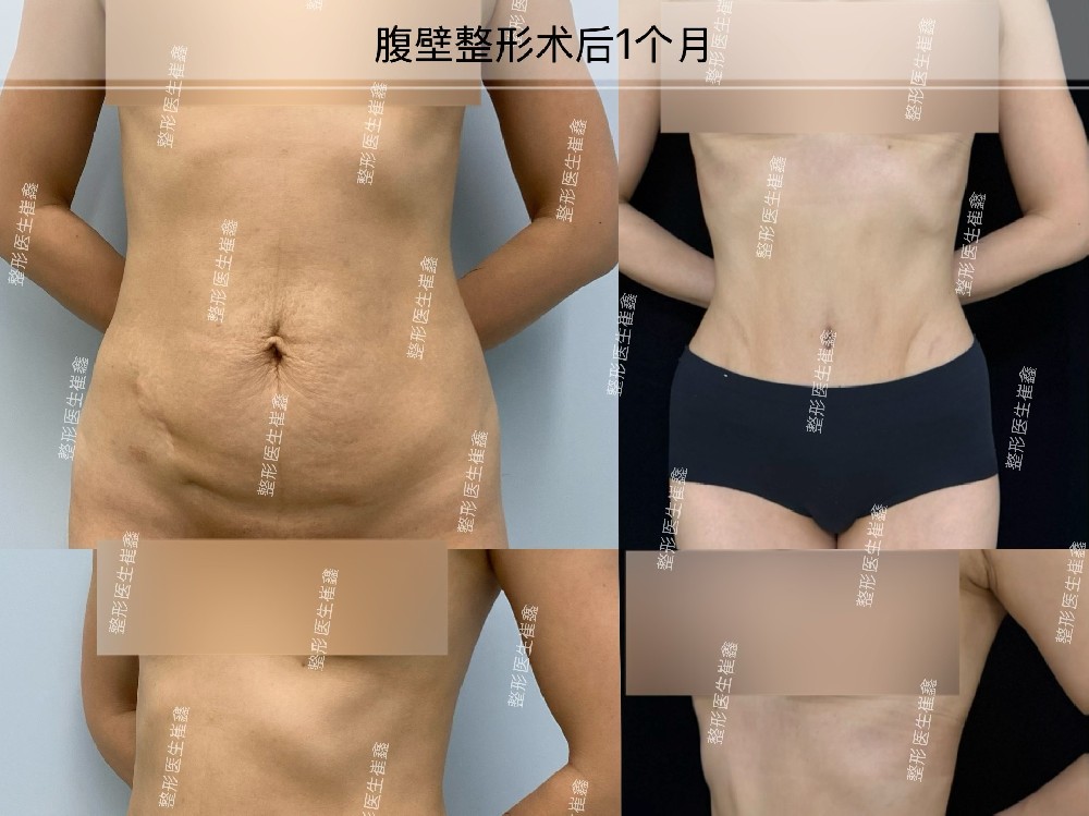 腹壁整形术后1个月