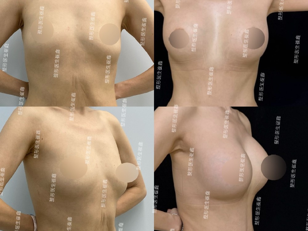 假体隆胸（Motiva 高凸375）术后3个月