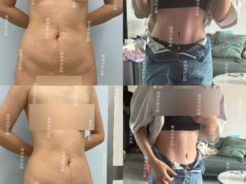 腹壁整形术后3个月