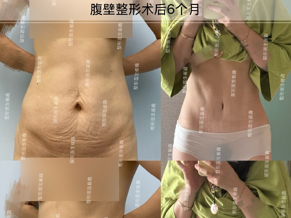 腹壁整形术后6个月