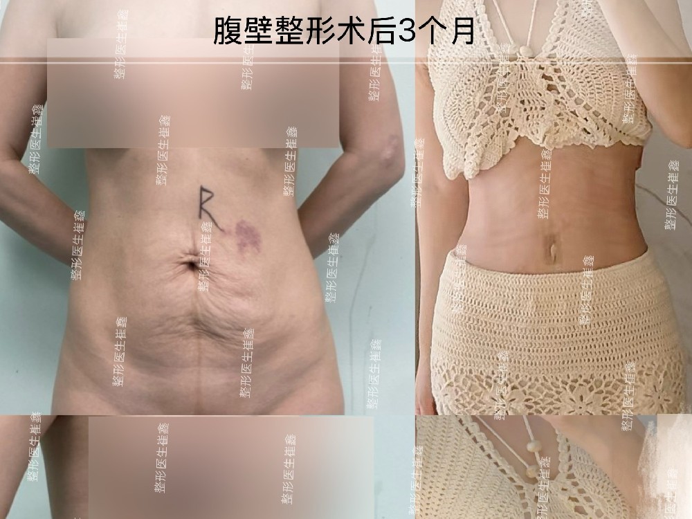 腹壁整形术后3个月