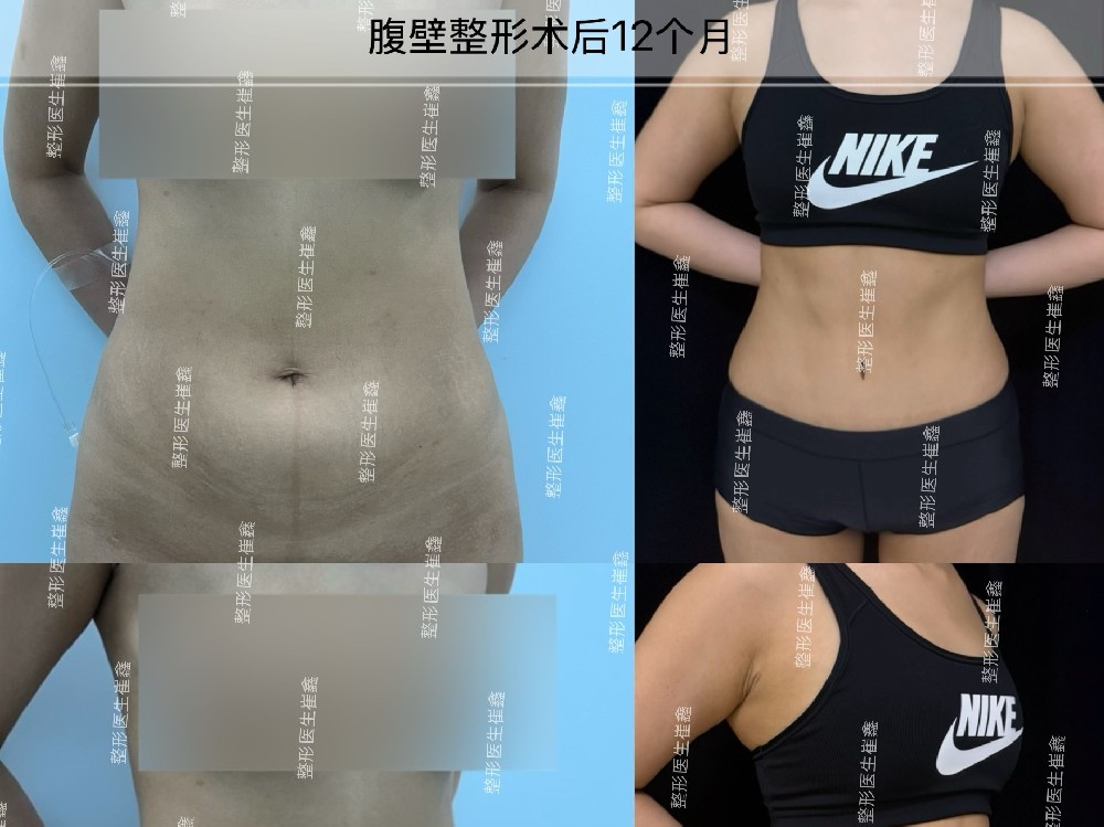 腹壁整形术后12个月