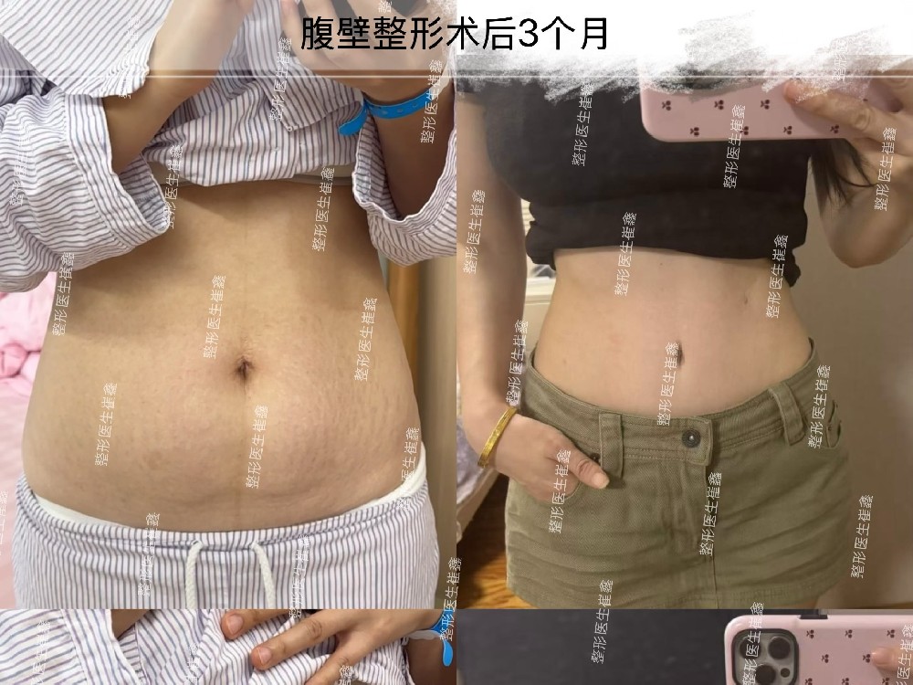 腹壁整形术后3个月