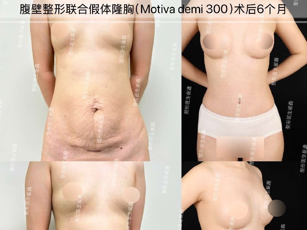 腹壁整形联合假体隆胸（Motiva demi 300）术后6个月