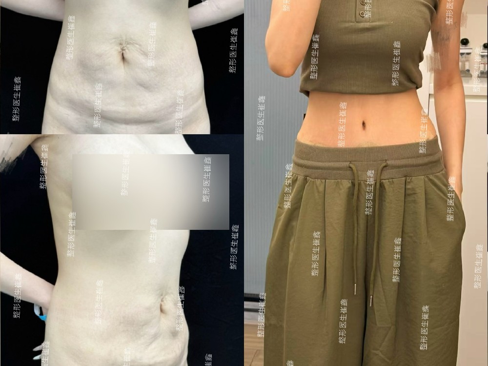 腹壁整形术后3个月