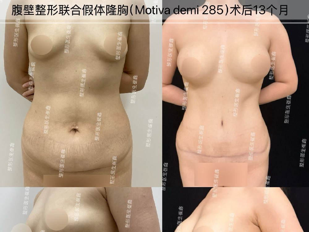 腹壁整形联合假体隆胸（Motiva demi 285）术后13个月