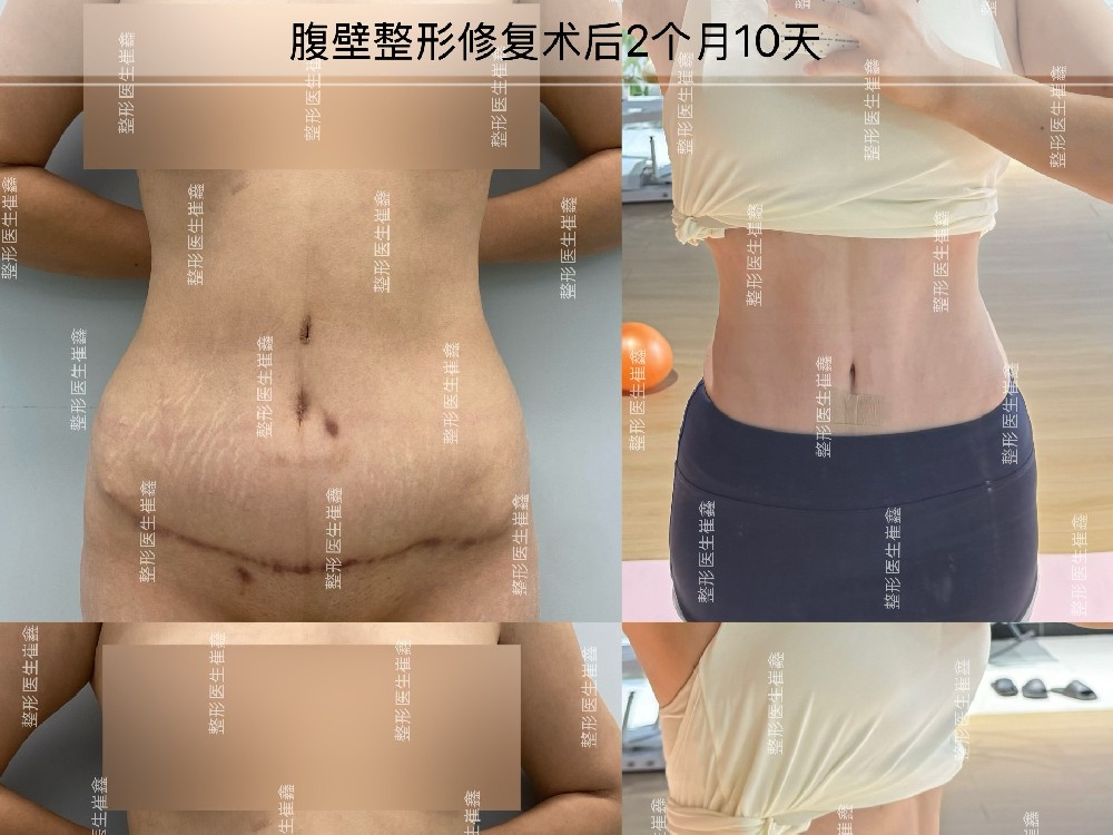 腹壁整形修复术后2个月10天