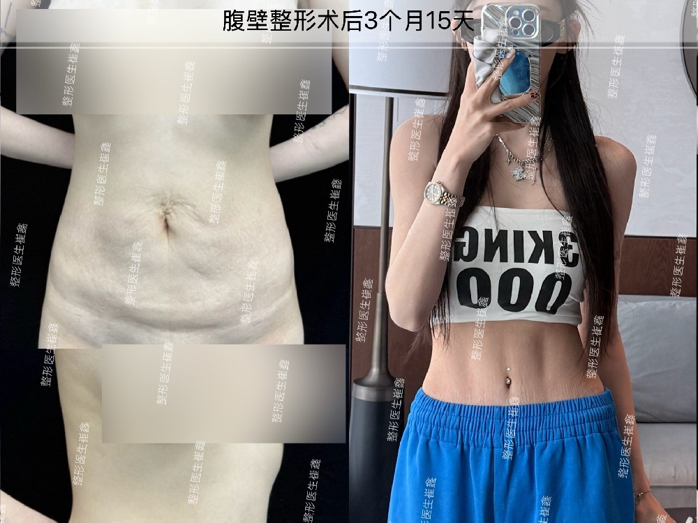 腹壁整形术后3个月15天