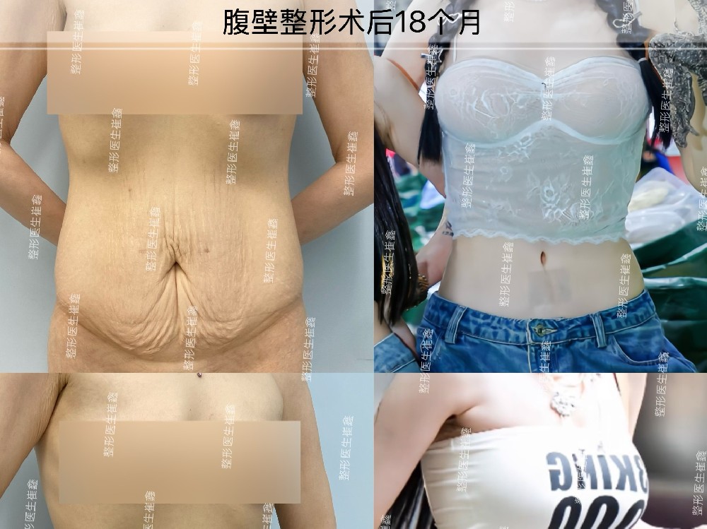腹壁整形术后18个月