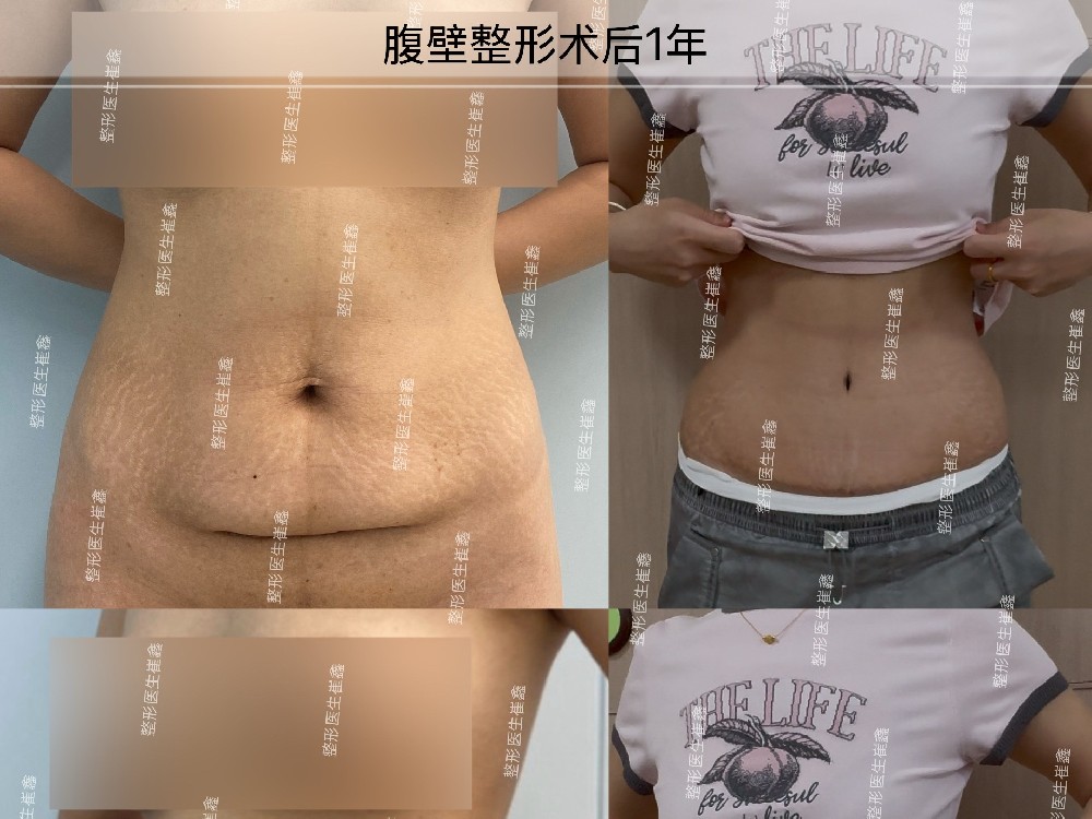 腹壁整形术后1年