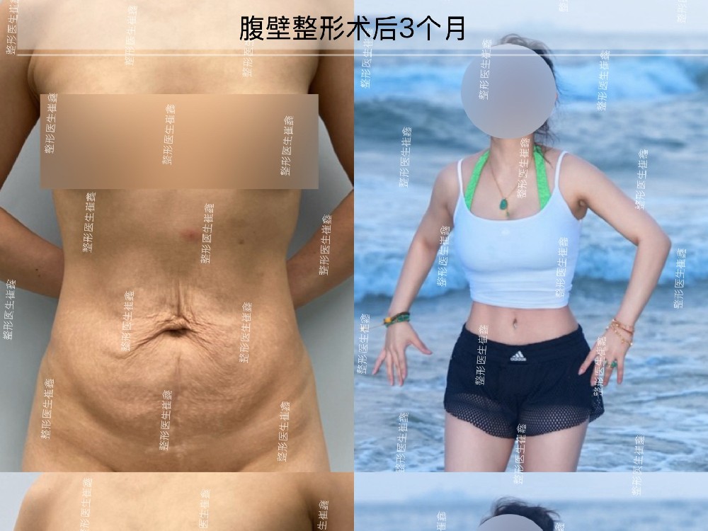 腹壁整形术后3个月