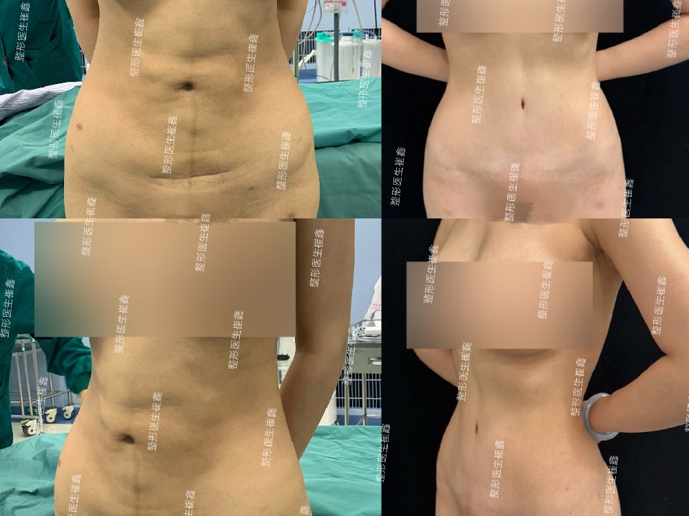 腹壁整形术后3年10个月