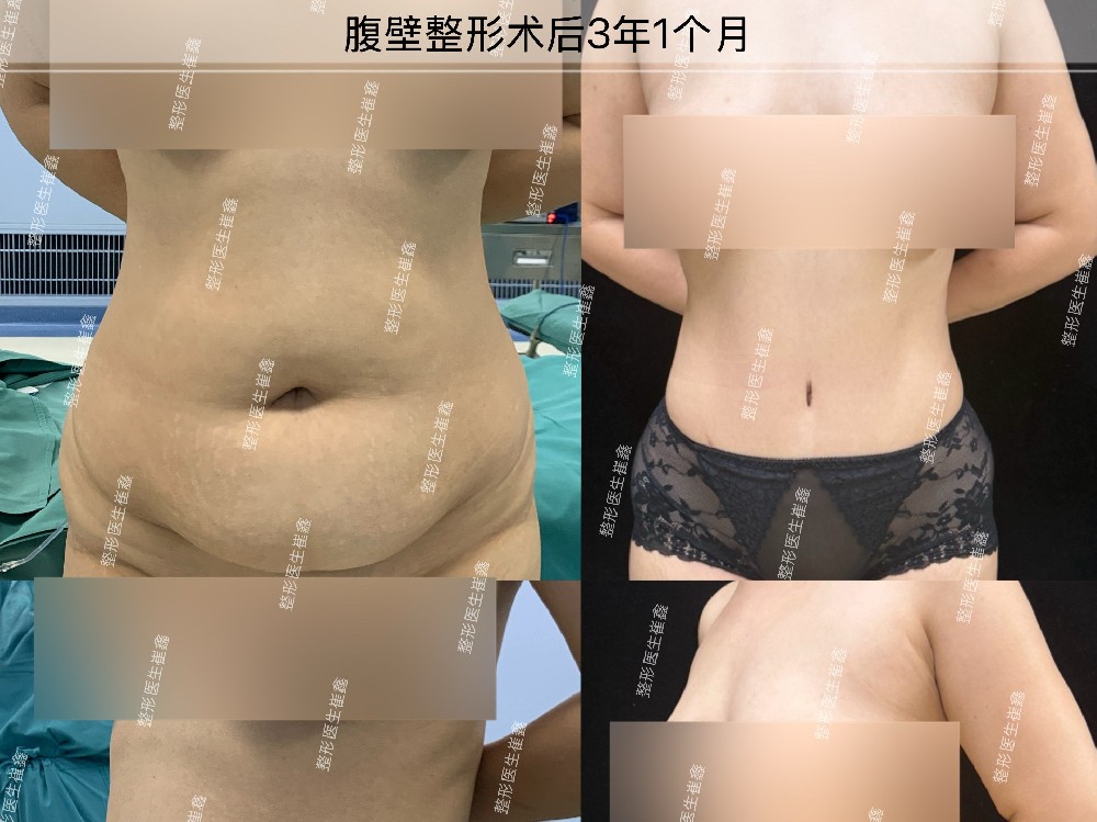 腹壁整形3年1个月