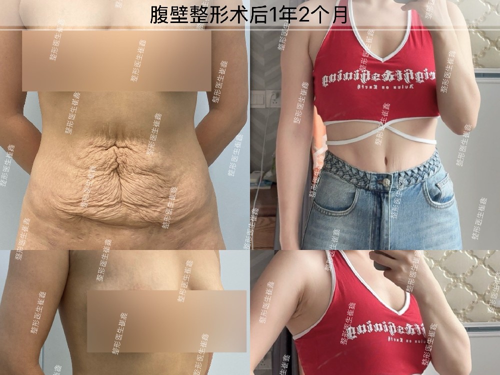 腹壁整形术后1年2个月