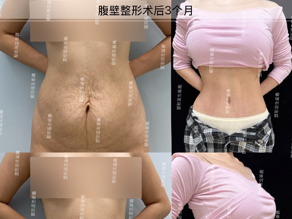 腹壁整形术后3个月
