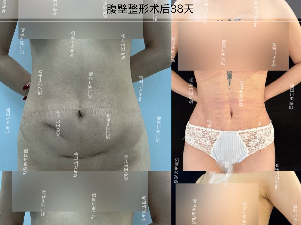腹壁整形术后38天