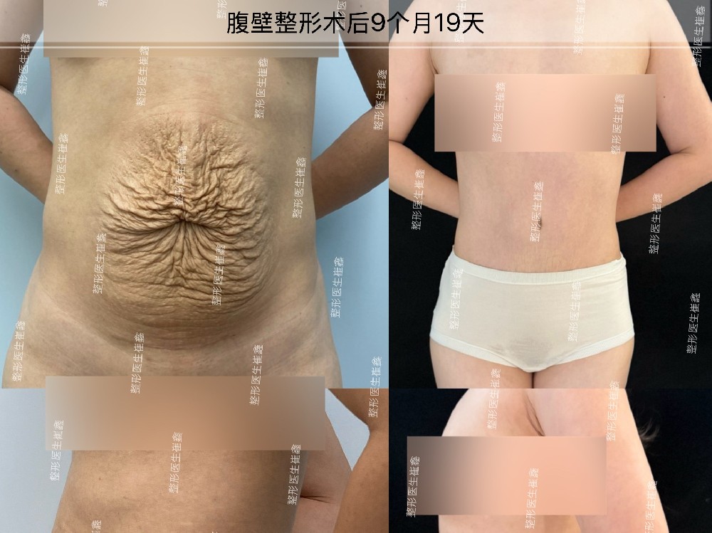 腹壁整形术后9个月19天