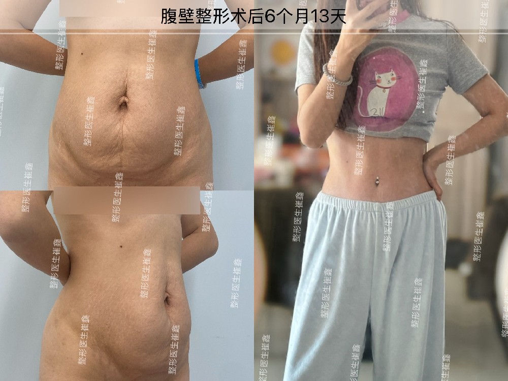 腹壁整形术后6个月13天