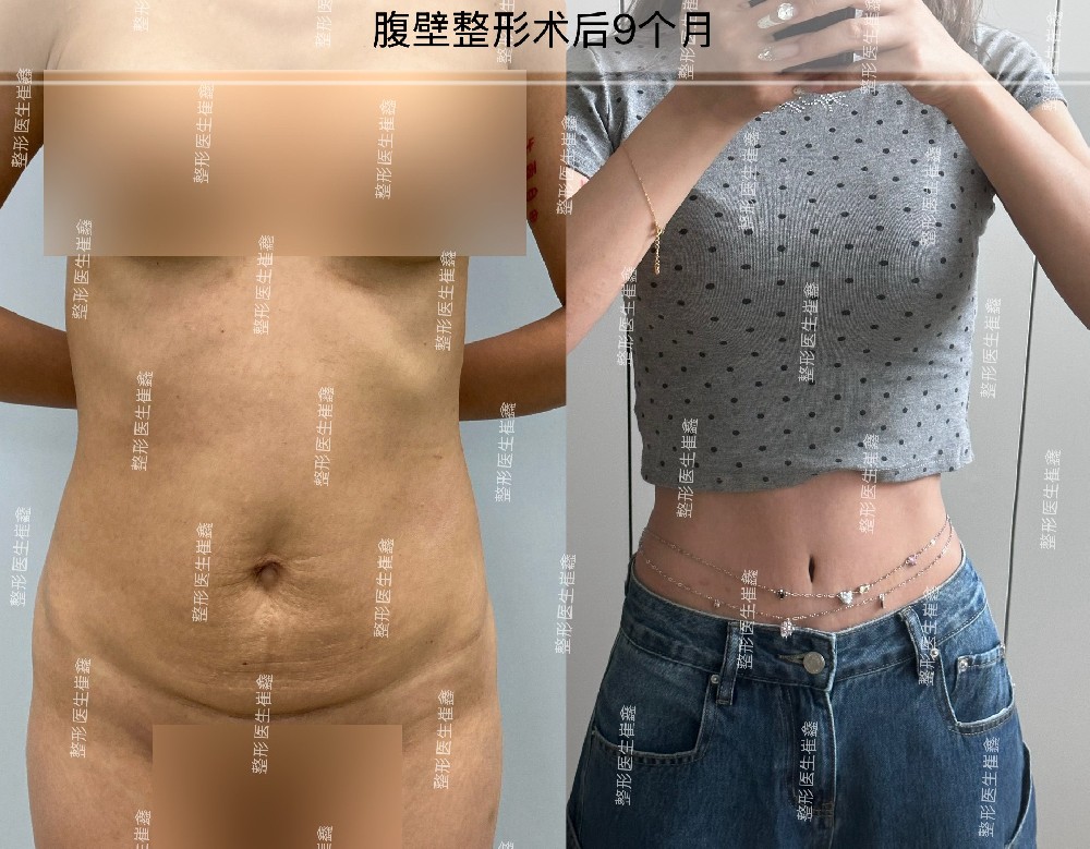 腹壁整形术后9个月