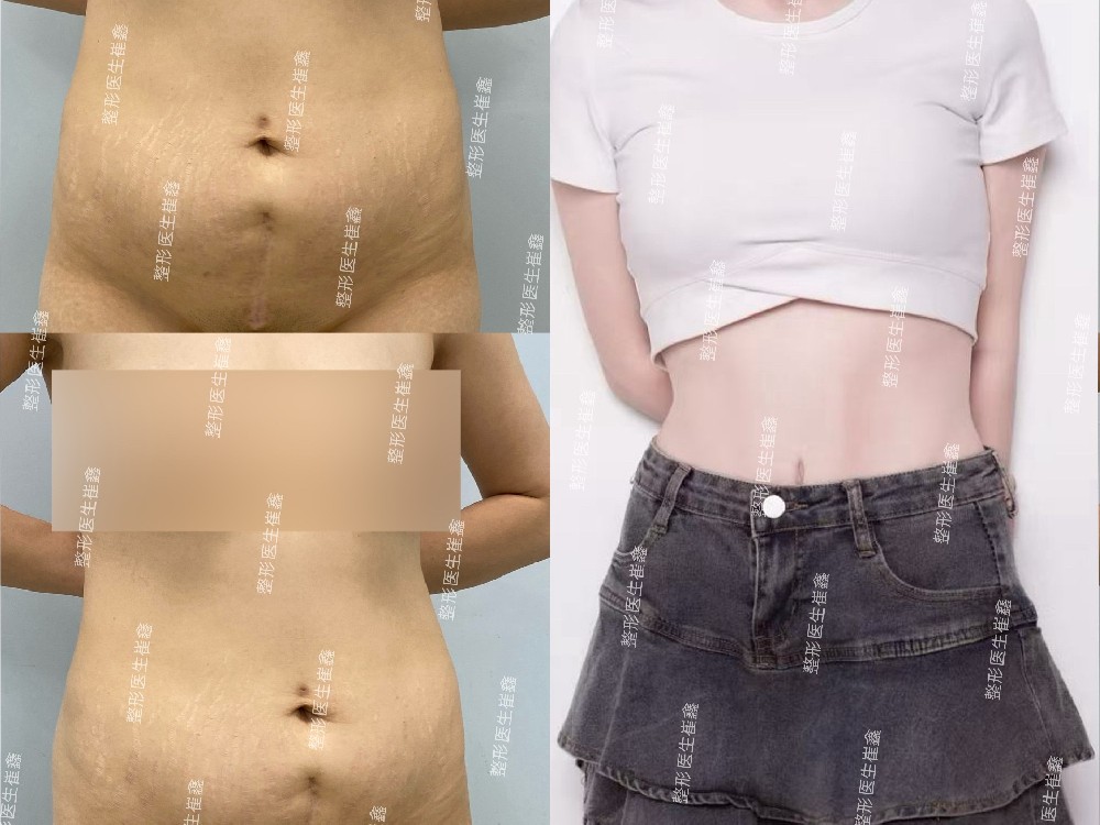 腹壁整形术后4个月