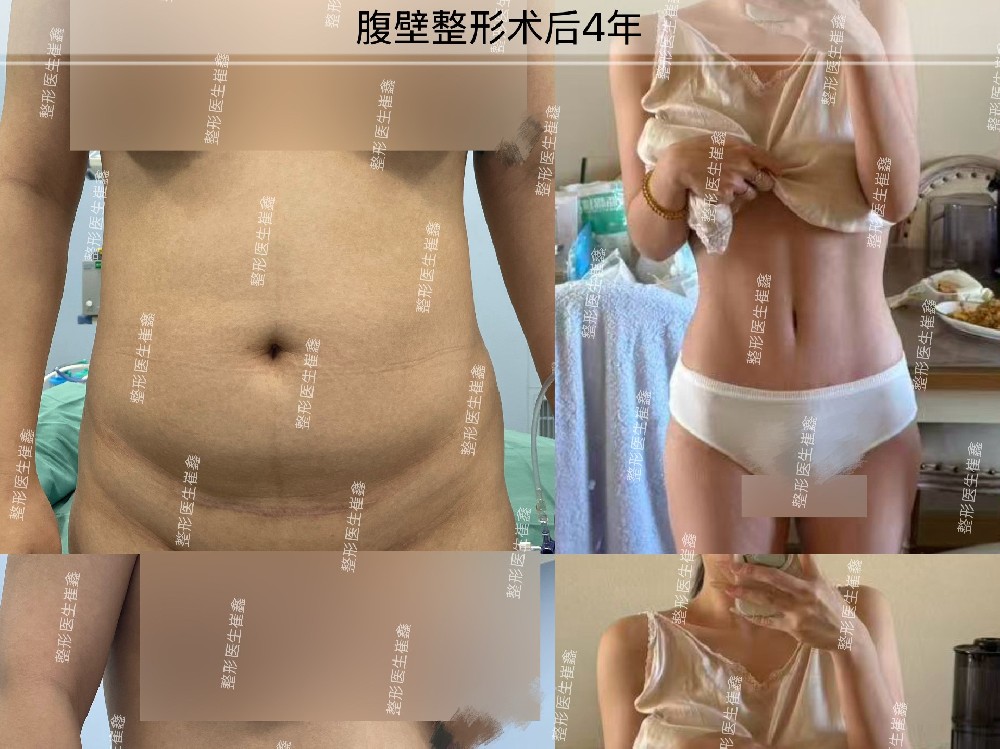 腹壁整形术后4年