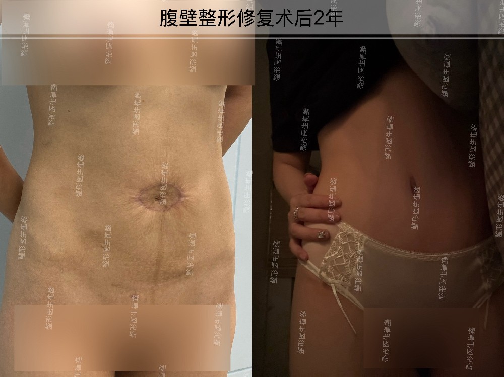 腹壁整形修复术后2年