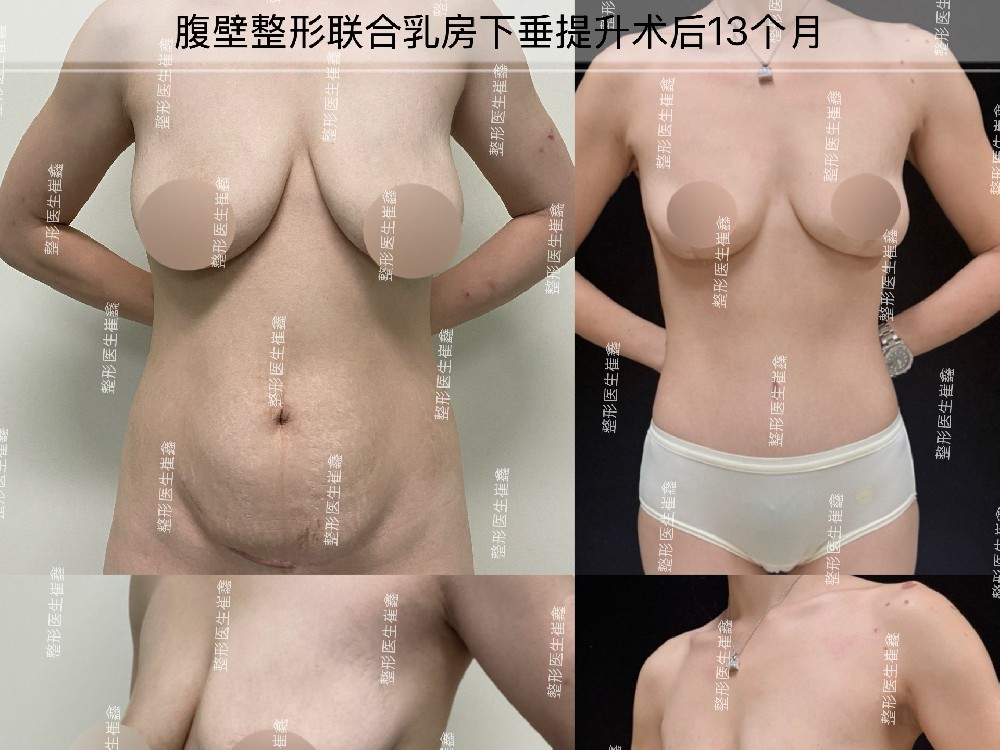 腹壁整形联合乳房下垂提升术后13个月