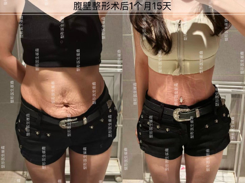 腹壁整形术后1个月15天