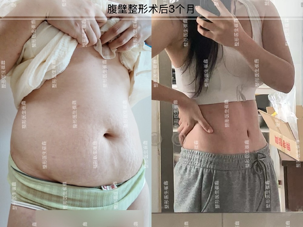 腹壁整形术后3个月