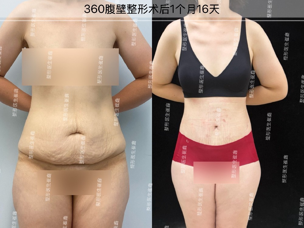 360腹壁整形术后1个月16天