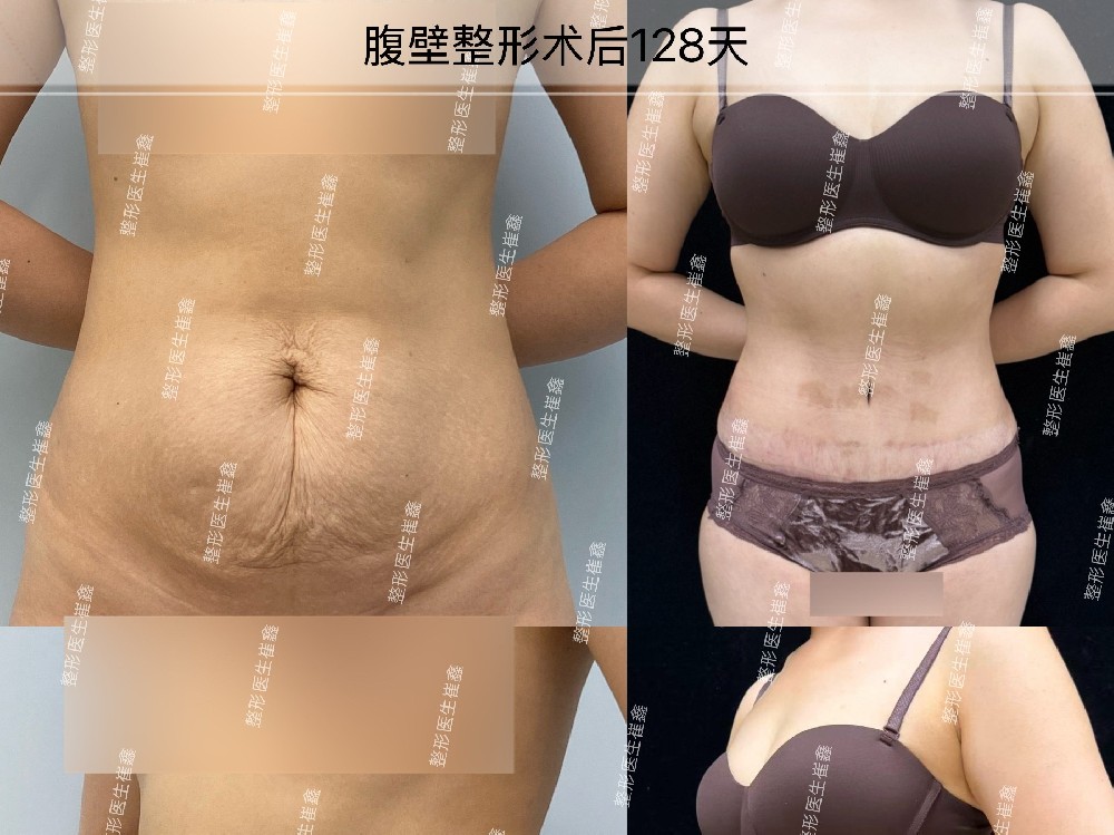 腹壁整形术后128天
