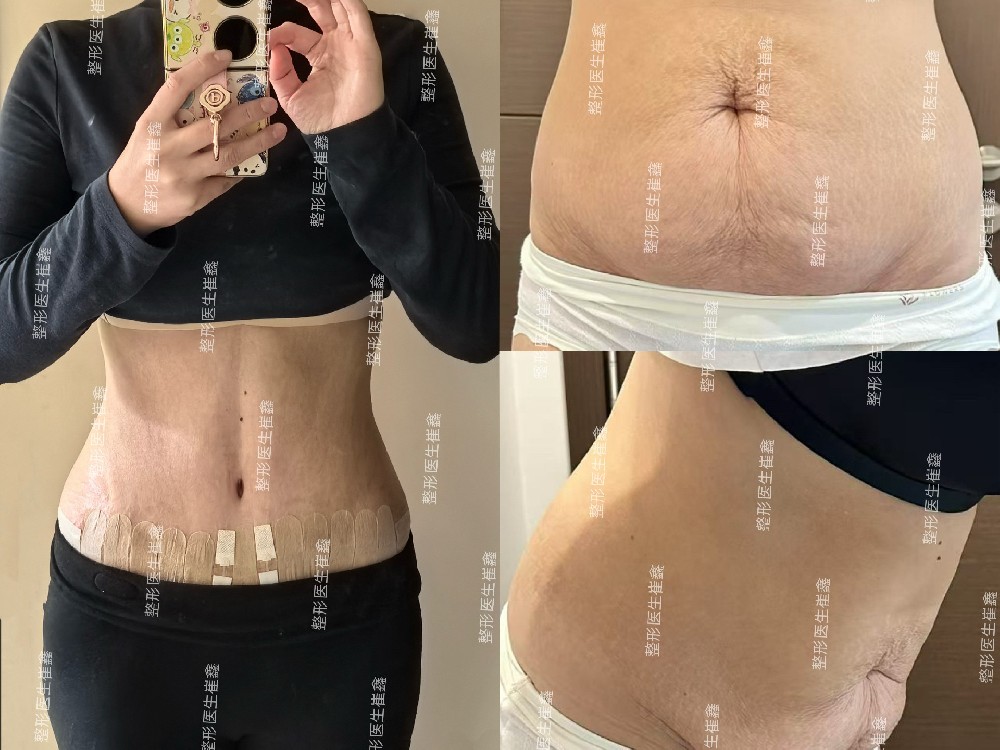 腹壁整形术后1个月22天