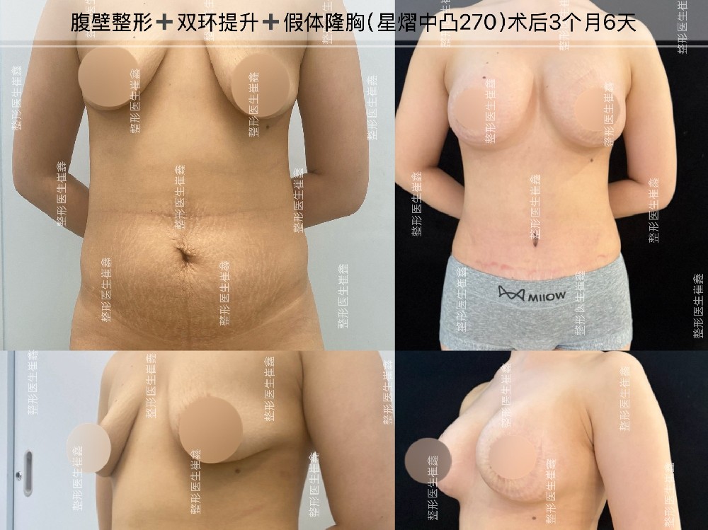 腹壁整形+双环+假体隆胸（星熠中凸270）术后3个月6天