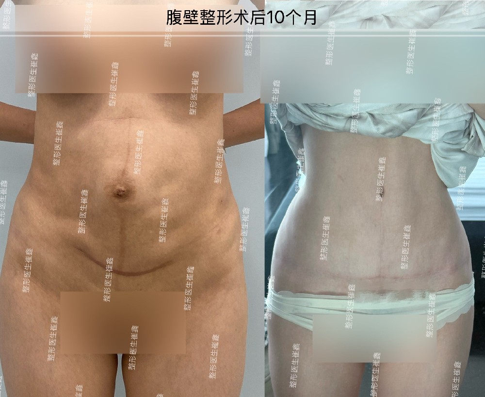 腹壁整形术后10个月
