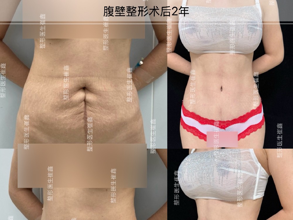 腹壁整形术后2年