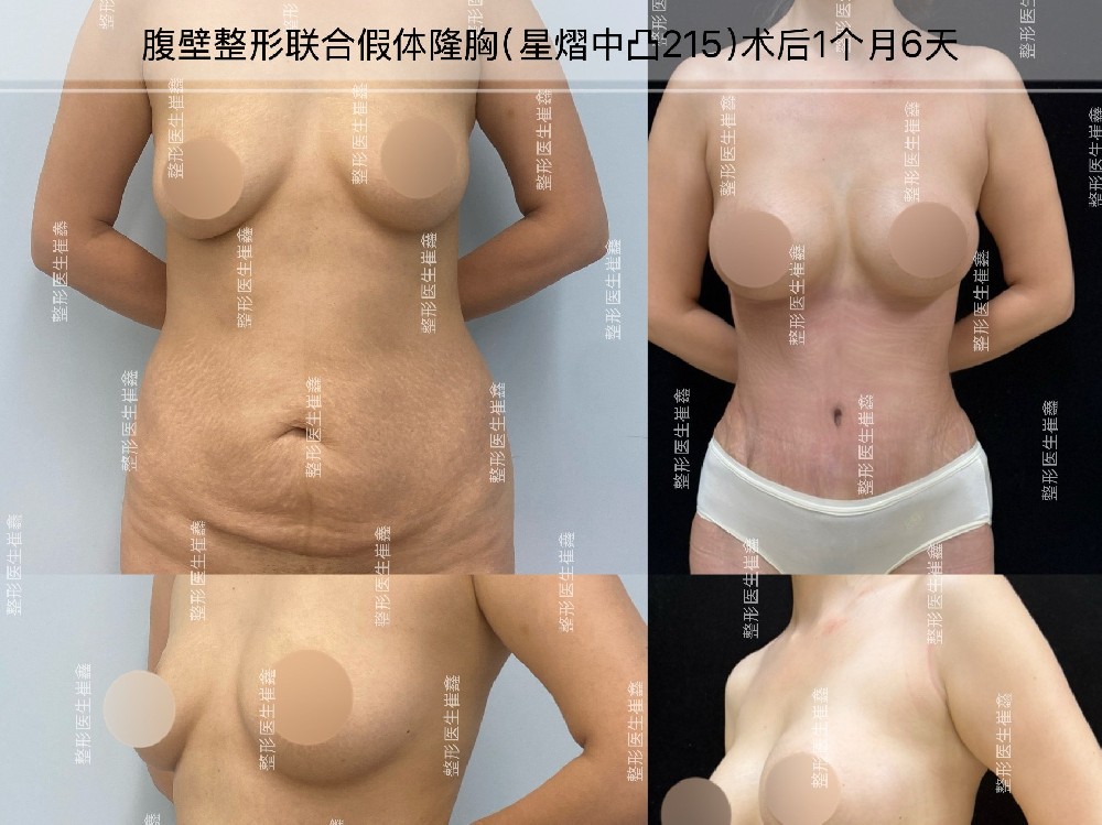腹壁整形联合假体隆胸（星熠中凸215）术后1个月6天