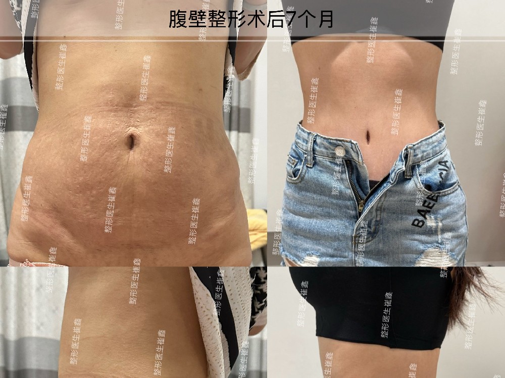 腹壁整形术后7个月
