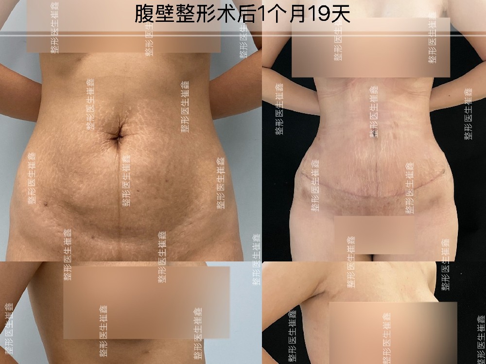 腹壁整形术后1个月19天