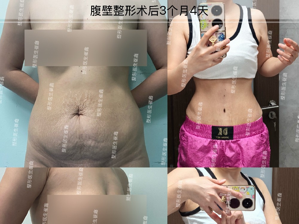 腹壁整形术后3个月4天