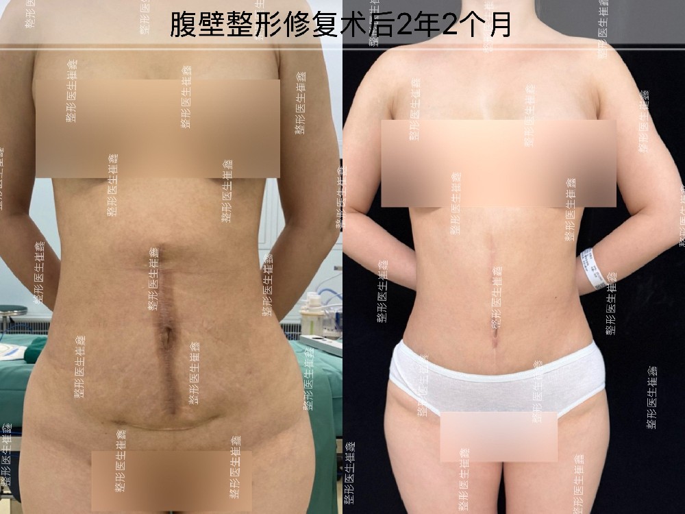 腹壁整形修复术后2年2个月